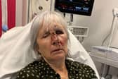 Glenn Lilley after she fell face first into the door as she collapsed before the tumour was discovered. 