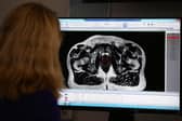 The scan of a patient diagnosed with prostate cancer